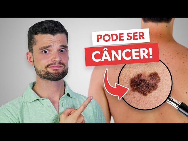 youtube image - 4 SKIN CANCER symptoms you need to know