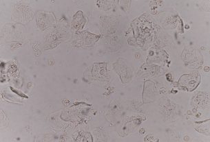 Epithelial cells in urine: what they could be and how to understand the test