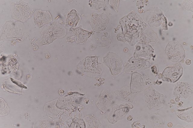 Epithelial cells in urine: what they could be and how to understand the test