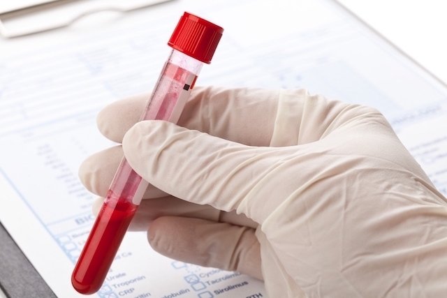 Cholinesterase test: what it is, what it is for and what the result means