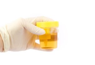 Positive nitrite in urine: what it means and how the test is done