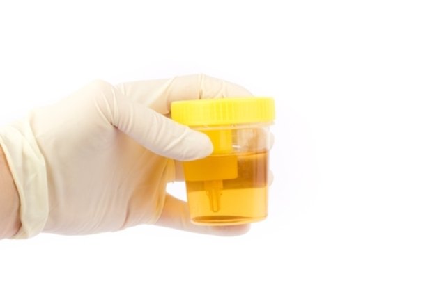 Positive nitrite in urine: what it means and how the test is done