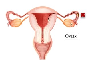 Infertility caused by blocked tubes