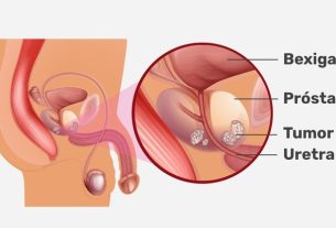 Prostate surgery: when it is indicated, how it is performed and recovery