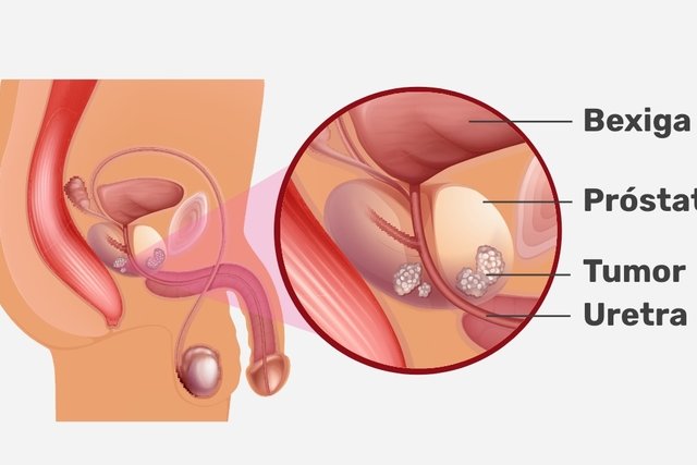 Prostate surgery: when it is indicated, how it is performed and recovery