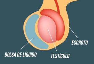 Hydrocele: what it is, how to identify it and how to treat it