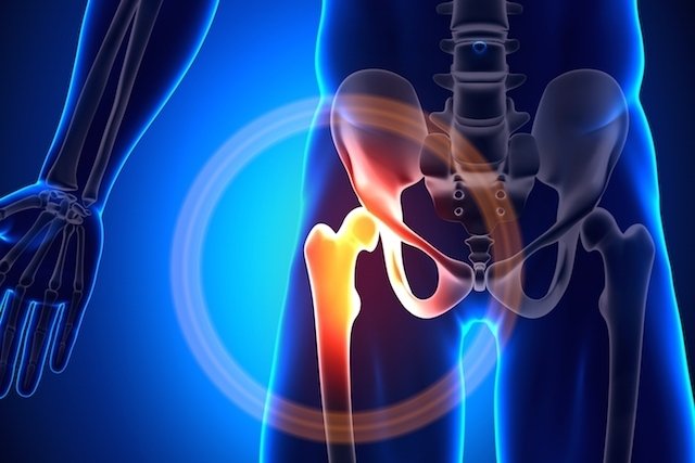 Hip osteoarthritis: what it is, symptoms, causes and treatment