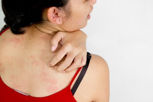 Skin allergy: symptoms, causes, types and treatment