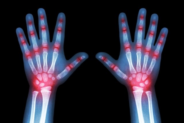 Reactive arthritis: what it is, treatment, symptoms and causes