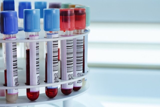 8 tests that confirm anemia