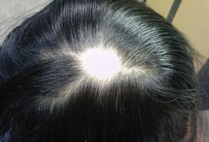 Alopecia areata: what it is, symptoms, causes and treatment