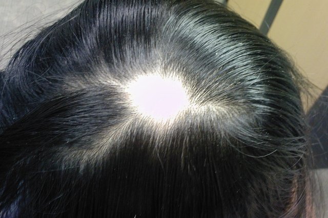 Alopecia areata: what it is, symptoms, causes and treatment