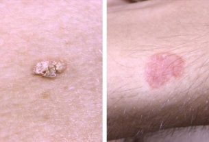 5 treatments for skin cancer (melanoma and non-melanoma)