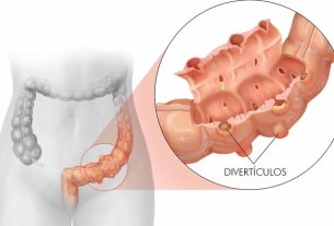 5 tips for living well with diverticulitis