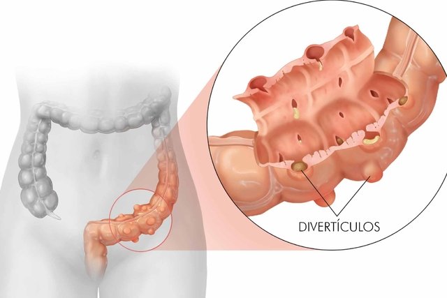 5 tips for living well with diverticulitis