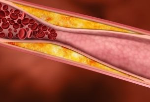 4 treatment options for atherosclerosis