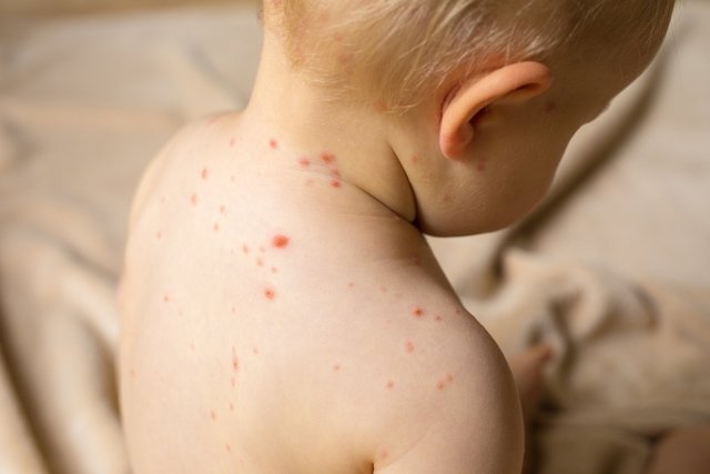 5 precautions during chickenpox and how long it lasts