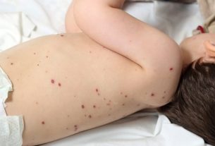 7 common questions about chickenpox