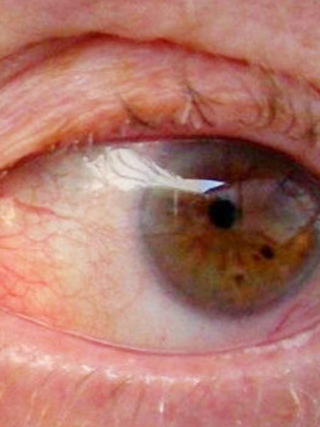 9 Glaucoma Symptoms You Should Not Avoid