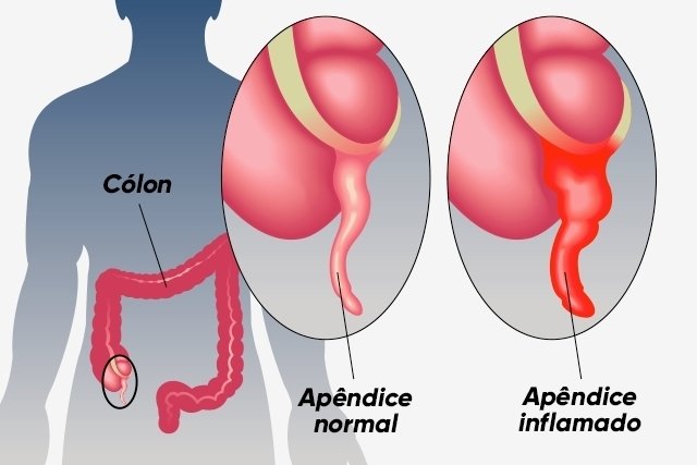 Acute appendicitis: what it is, symptoms, causes and treatment