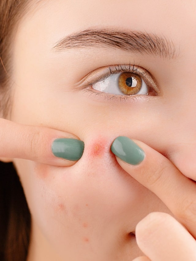 All you need to know about pimple patches