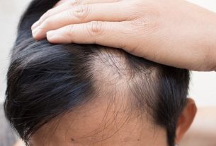 Alopecia: what it is, symptoms, causes, types and treatment