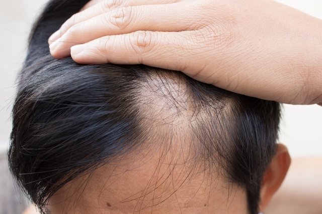 Alopecia: what it is, symptoms, causes, types and treatment