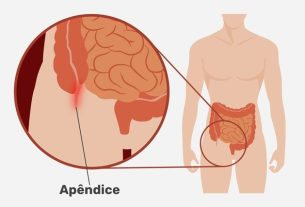 Appendicitis pain: what it’s like, how many days it lasts and what to do