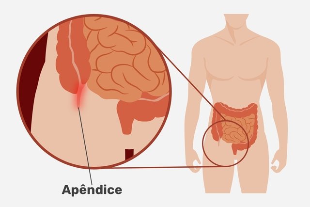 Appendicitis pain: what it’s like, how many days it lasts and what to do