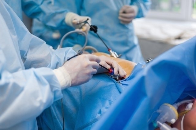 Appendicitis surgery: how it is done, risks and recovery