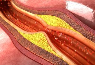 Atherosclerosis: what it is, symptoms, causes and treatment