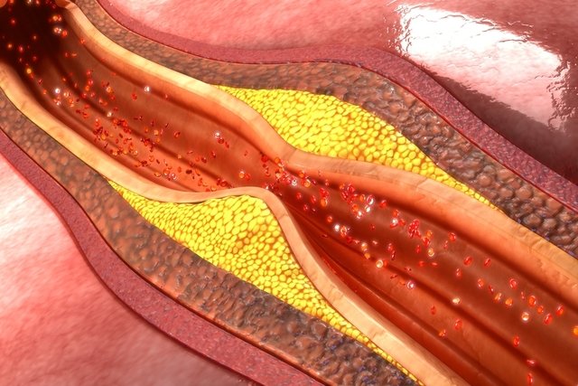 Atherosclerosis: what it is, symptoms, causes and treatment