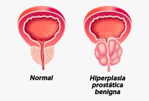 Benign prostate hyperplasia: what it is, symptoms, causes and treatment