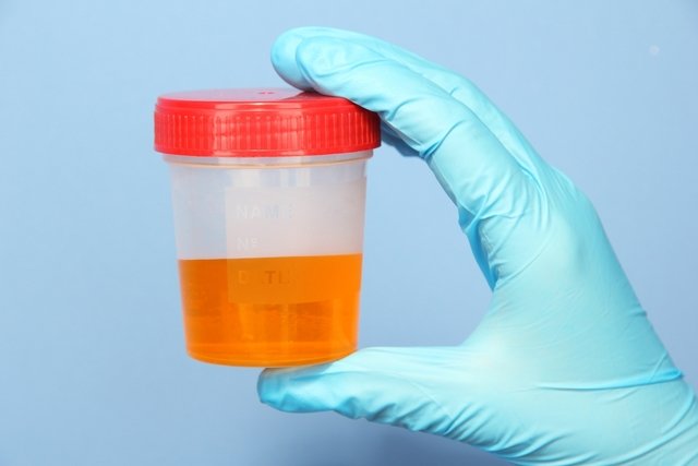 Bilirubin in urine: what it could be and what to do