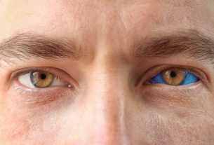 Blue sclera: what it is, symptoms, causes and what to do