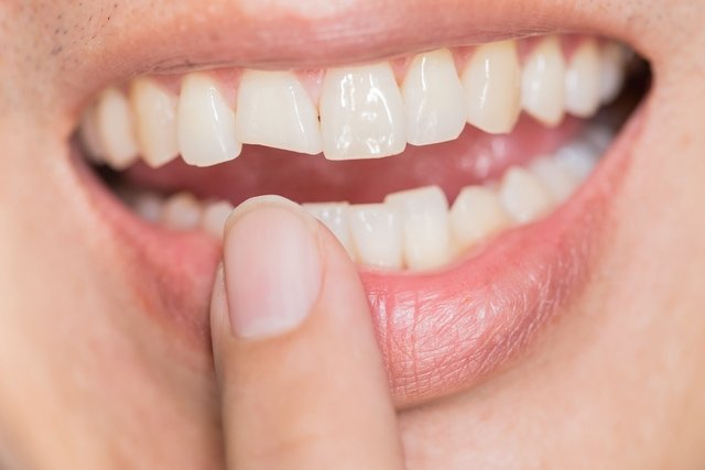 Broken tooth: symptoms, causes and what to do