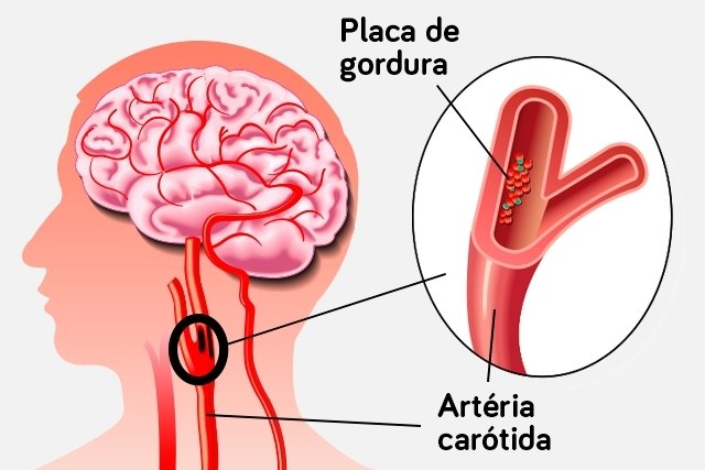 Carotid Doppler: what it is, when it is indicated and how it is done