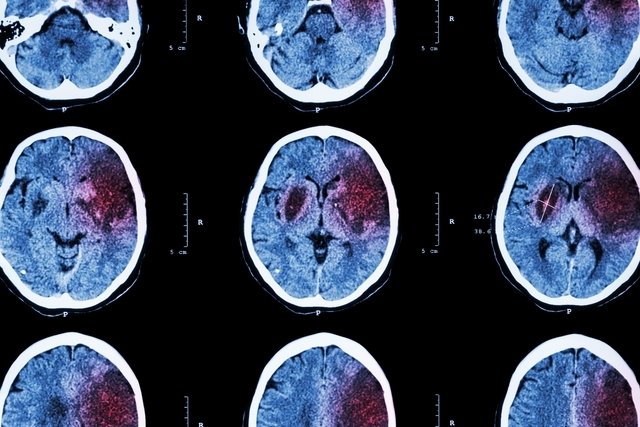 Cerebral hemorrhage: symptoms, causes, treatment and consequences