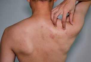 Chickenpox in adults: symptoms, possible complications and treatment