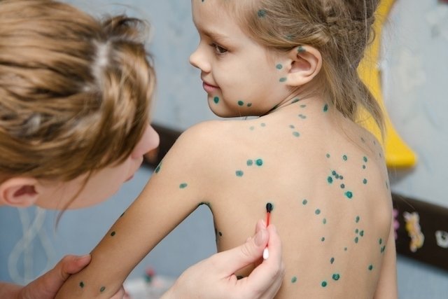 Chickenpox: what it is, symptoms, causes and treatment