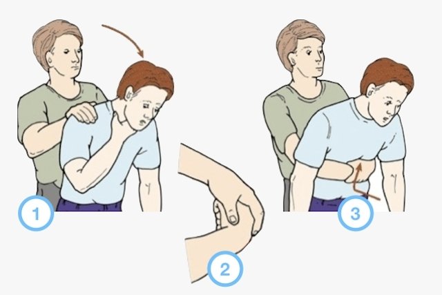 Choking: first aid for choking