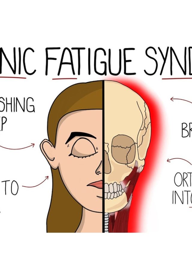 Chronic Fatigue Syndrome: Top 10 Symptoms Of CFS Disease