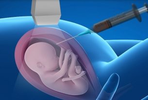 Cordocentesis: what it is, when to do it and possible risks