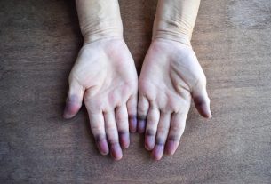 Cyanosis: what it is, types, causes and treatment