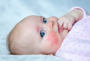 Erythema infectiosum: what it is, symptoms, cause and treatment