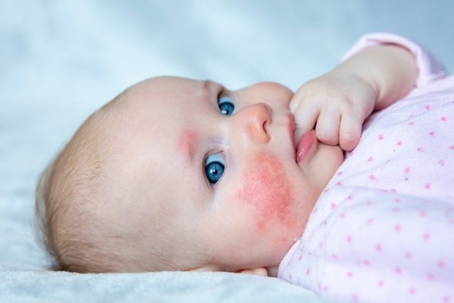 Erythema infectiosum: what it is, symptoms, cause and treatment