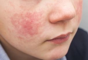 Erythema: what it is, symptoms, types, causes and treatment