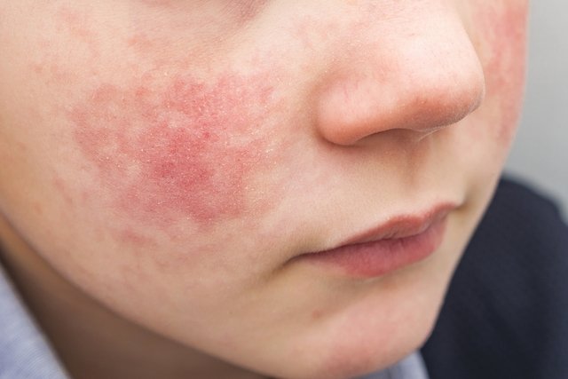 Erythema: what it is, symptoms, types, causes and treatment