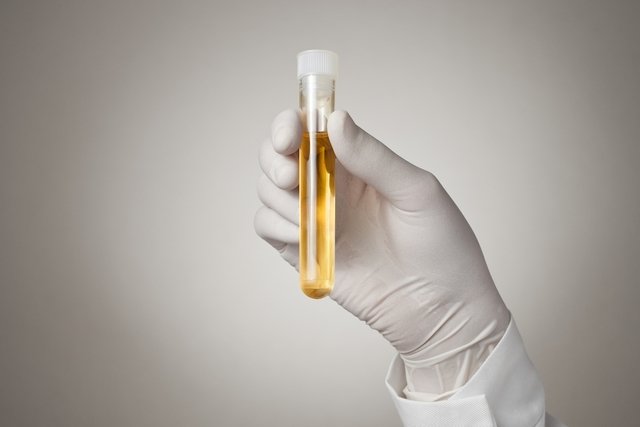 Fat in urine: what it could be and what to do