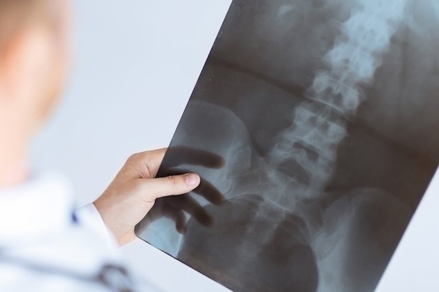 Fractures: symptoms, causes, types and treatment